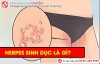 Herpes sinh dục có những triệu chứng nào?